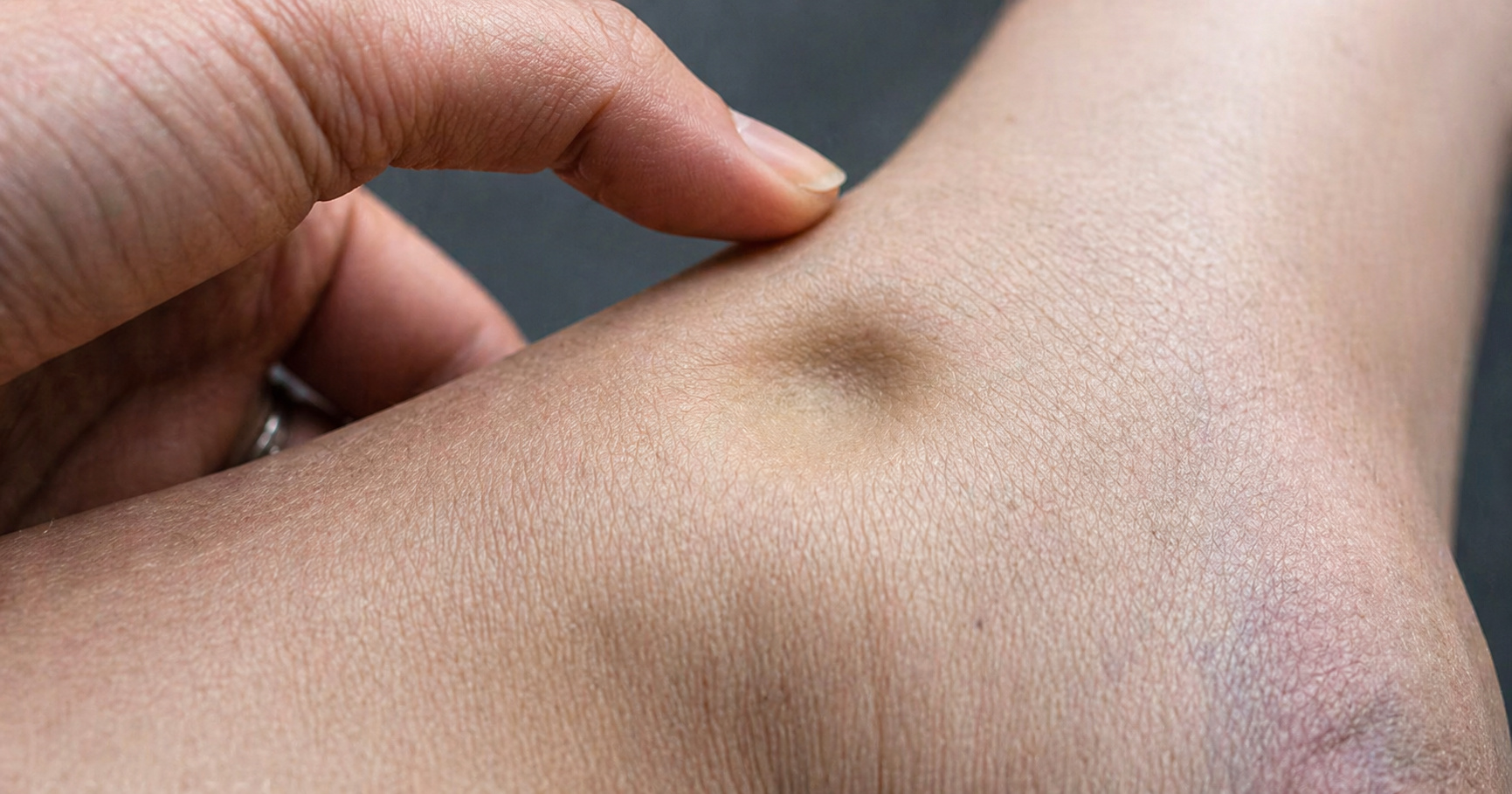 Escala de Cacifo: definição, técnica e aplicações clínicas para uma avaliação precisa do edema